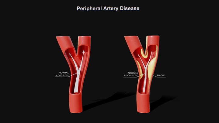 Peripheral Artery Disease 3D Model