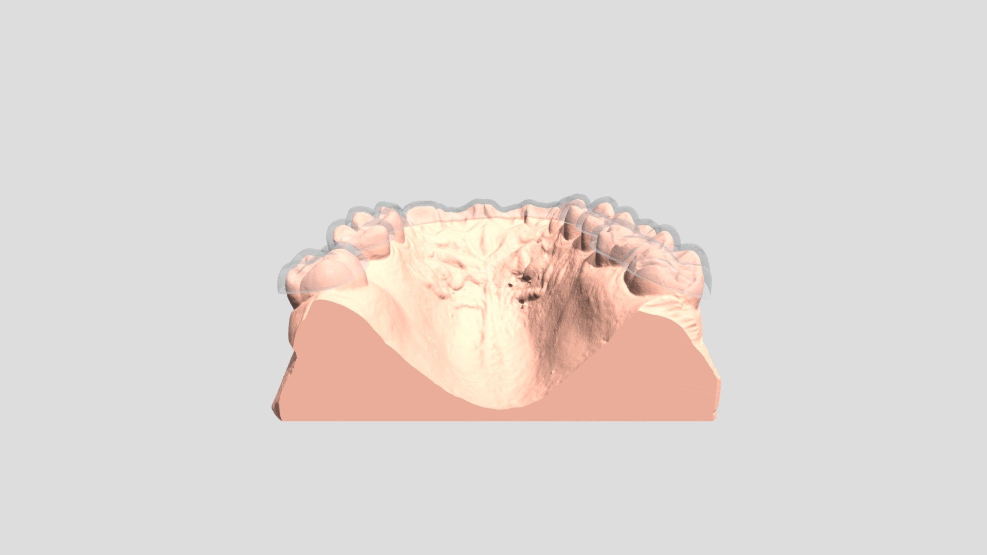 C109 Dental Splint Bridged