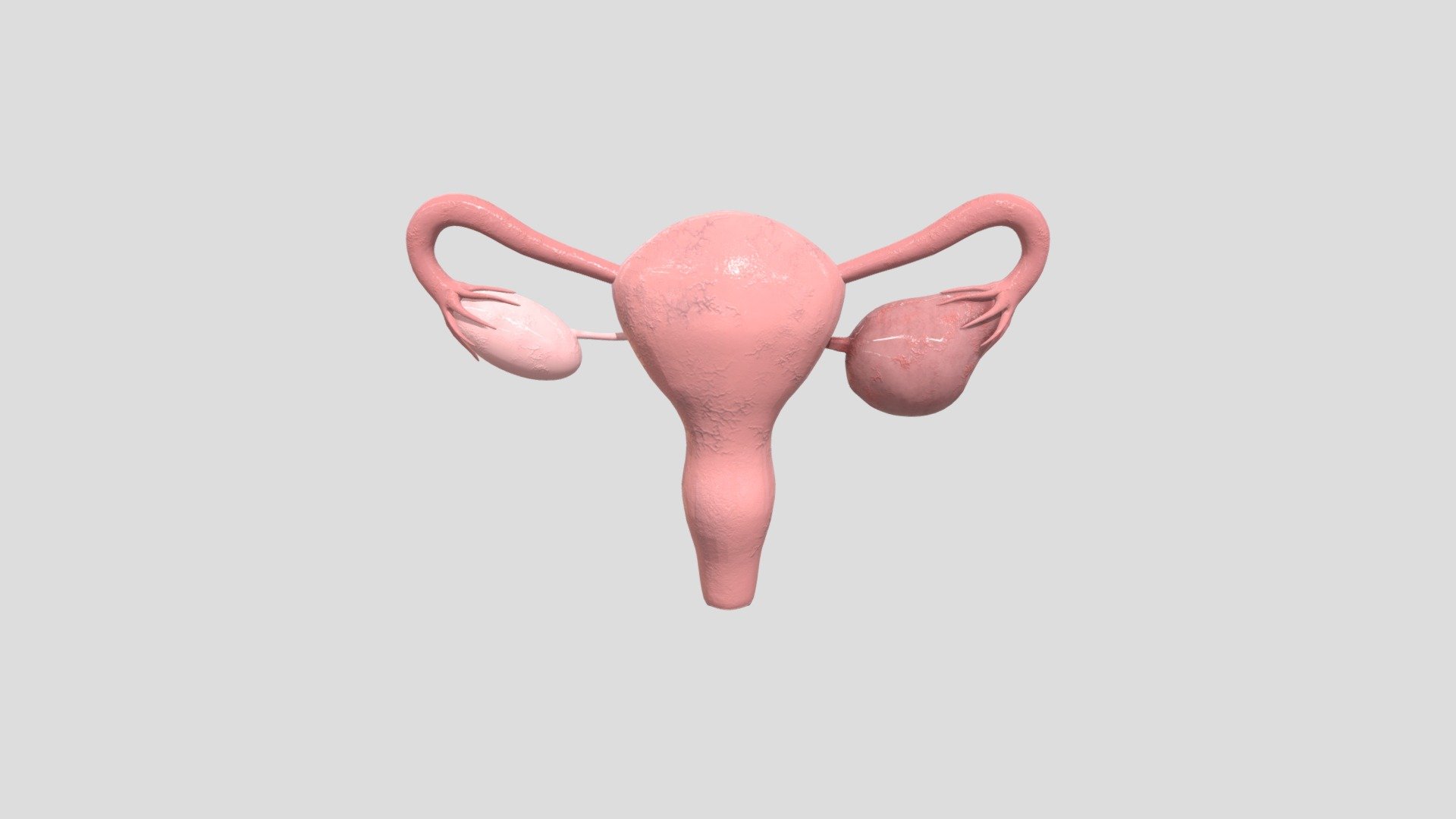 OVARIUM_CYST
