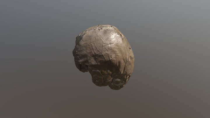 Dura Aneurysm 3D Model