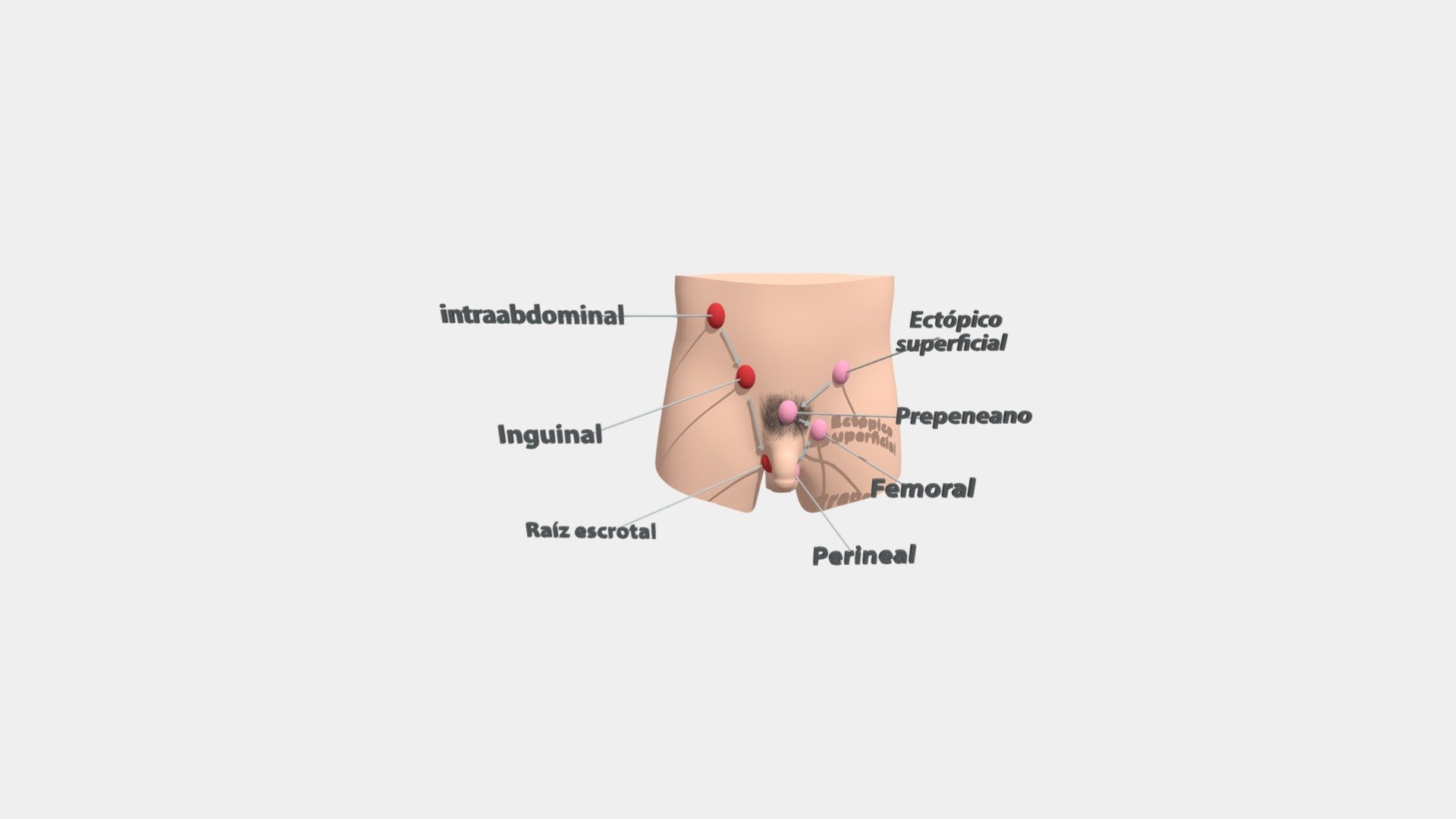 descenso testicular