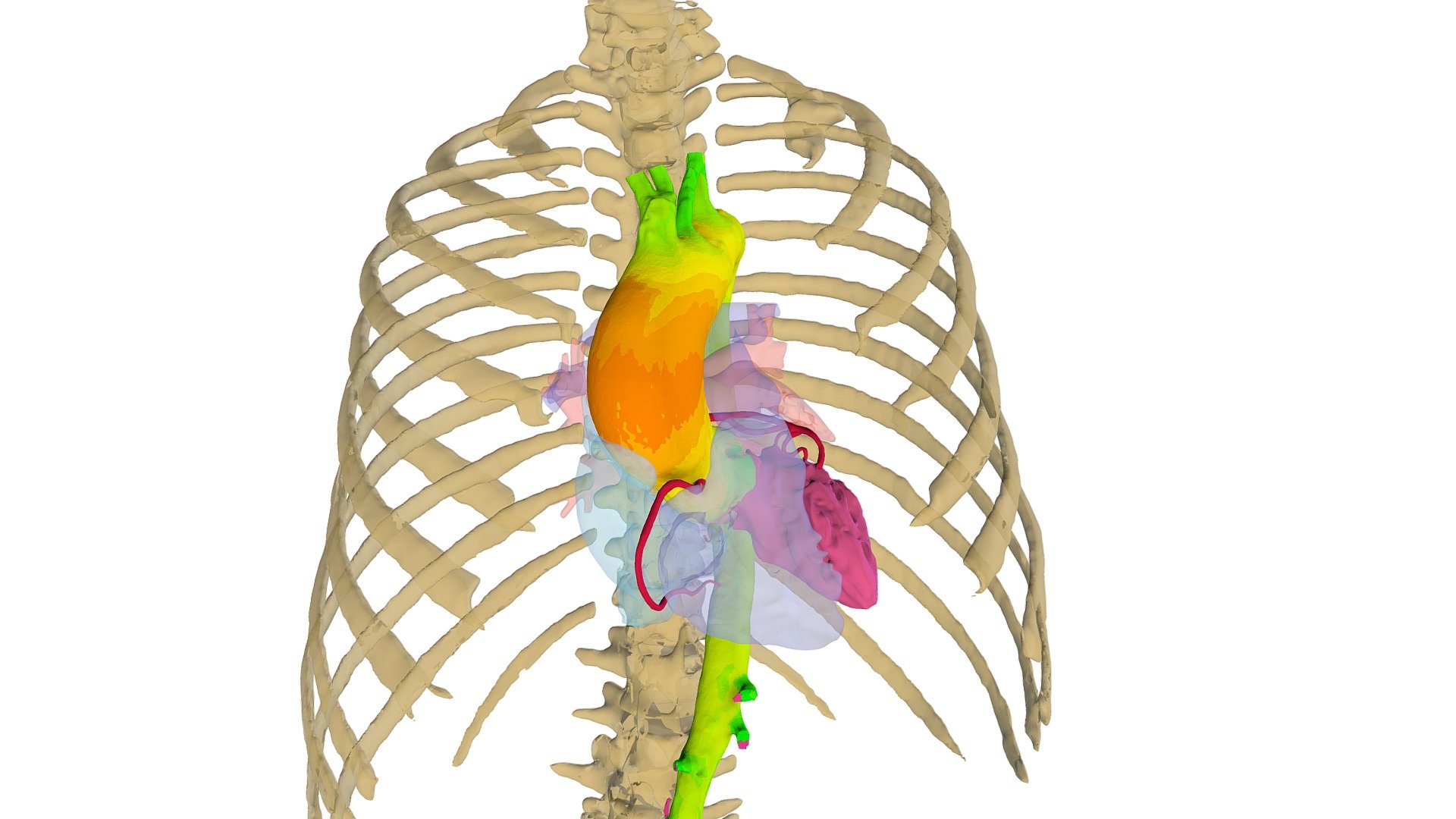 Planificació virtual avançada d'aorta — Sketchfab embed 3D viewer