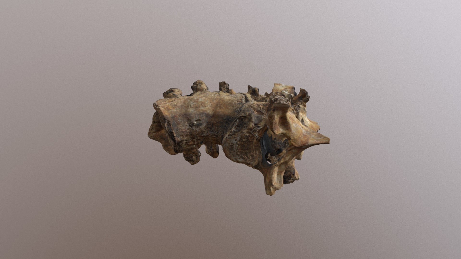 Pott's Disease - 1st To 10th Thoracic Vertebra - 3d Model By Bu 