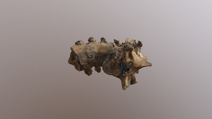 Pott's Disease - 1st to 10th thoracic vertebra 3D Model