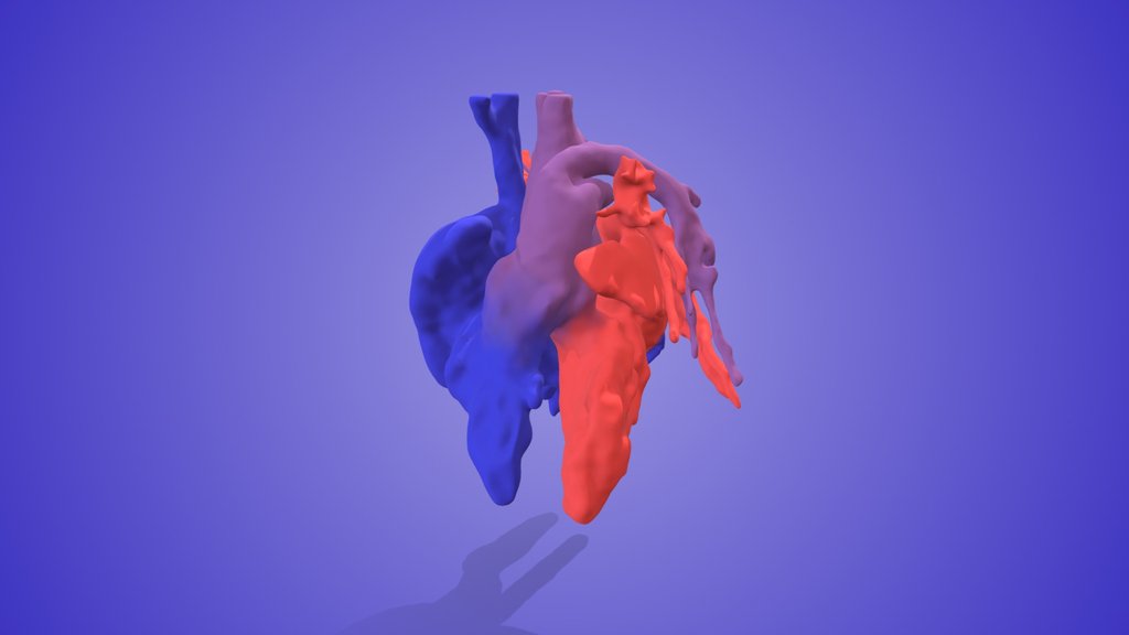 Truncus Arteriosus