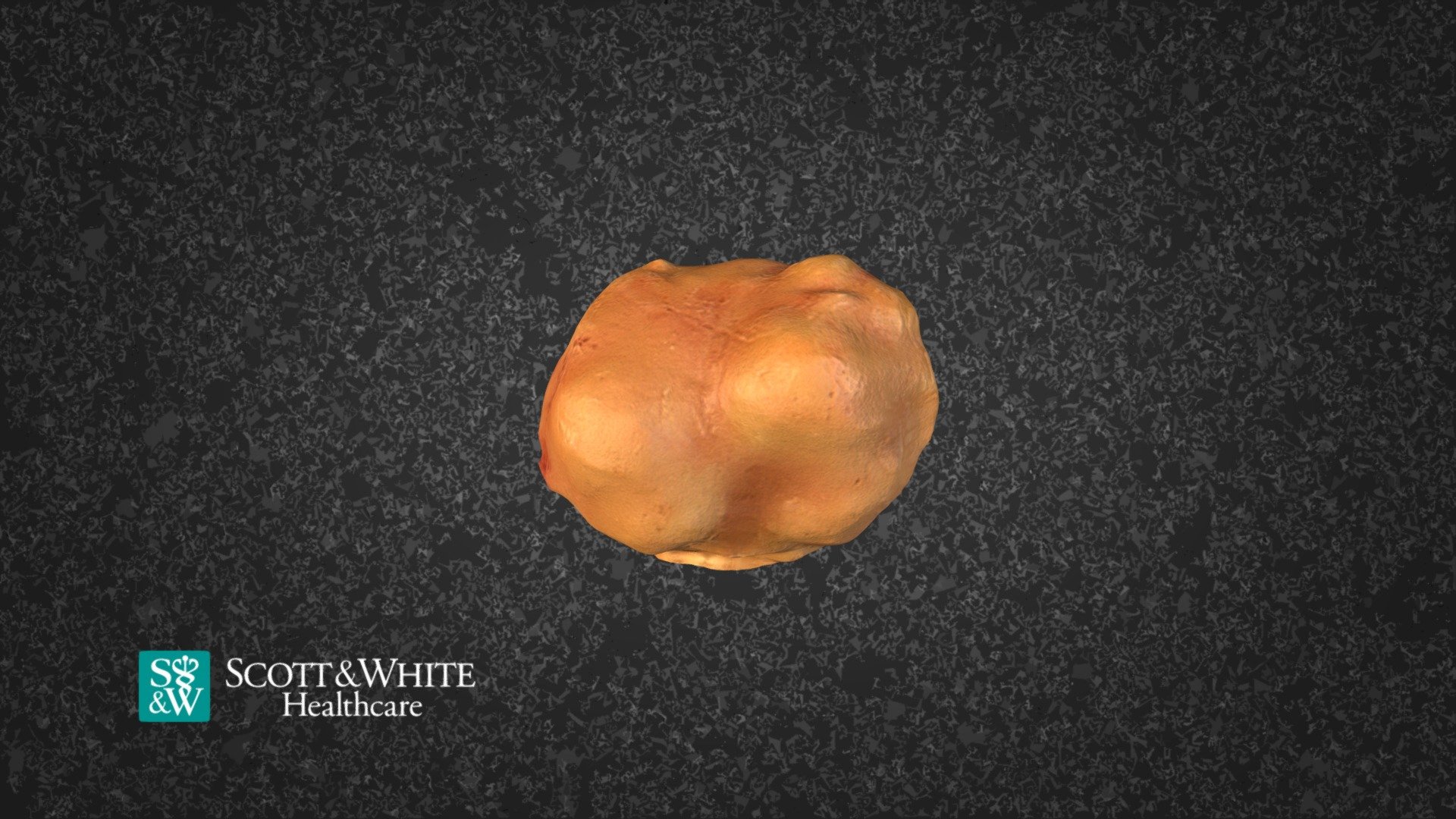 Ovarian Cyst 134320 - 3D model by Scott & White Moulage Project ...