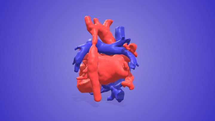 Coarctation 3D Model