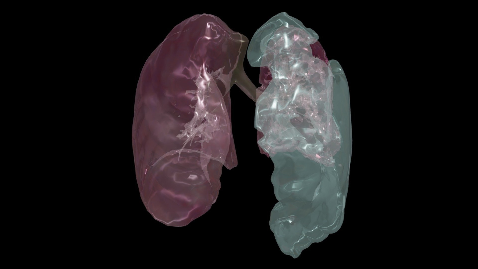 Left Pneumothorax