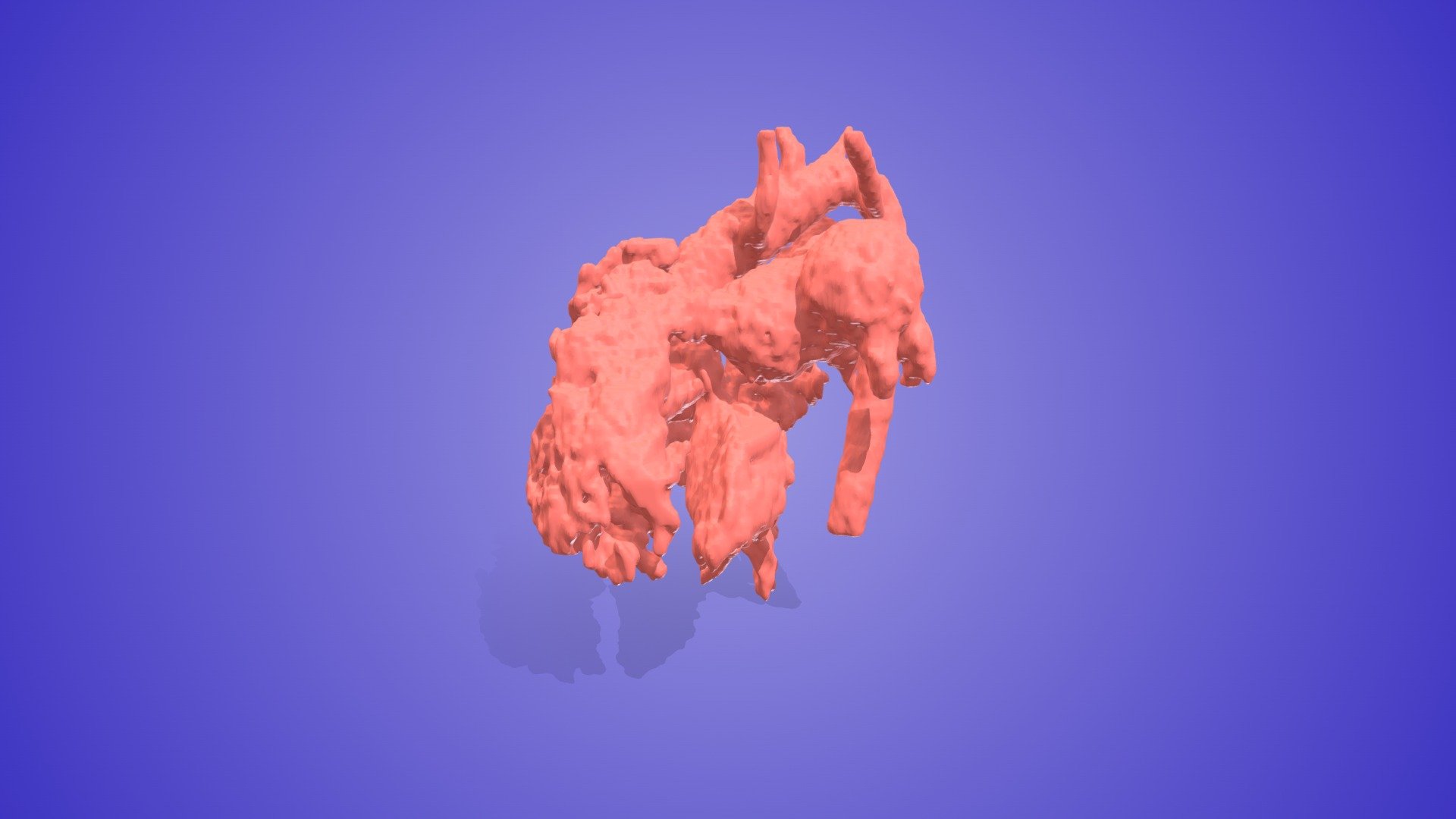 Tetralogy of Fallot with Absent Pulmonary Valve