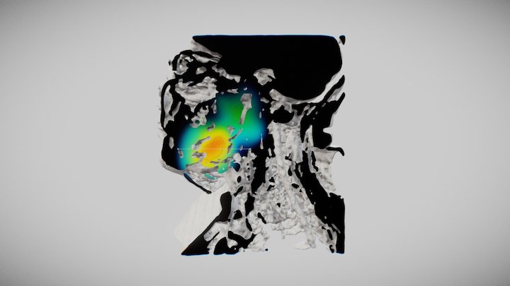 Dose Plan 3D Model