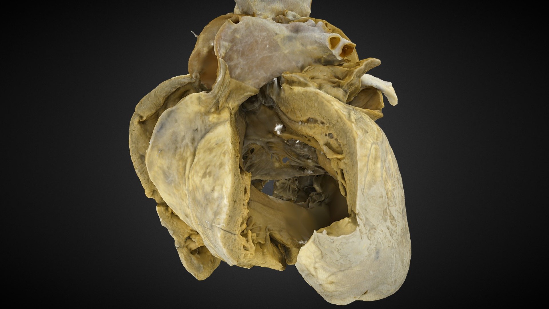 36: CAVC Rastelli C - 3D model by CHOP Cardiac Specimens ...