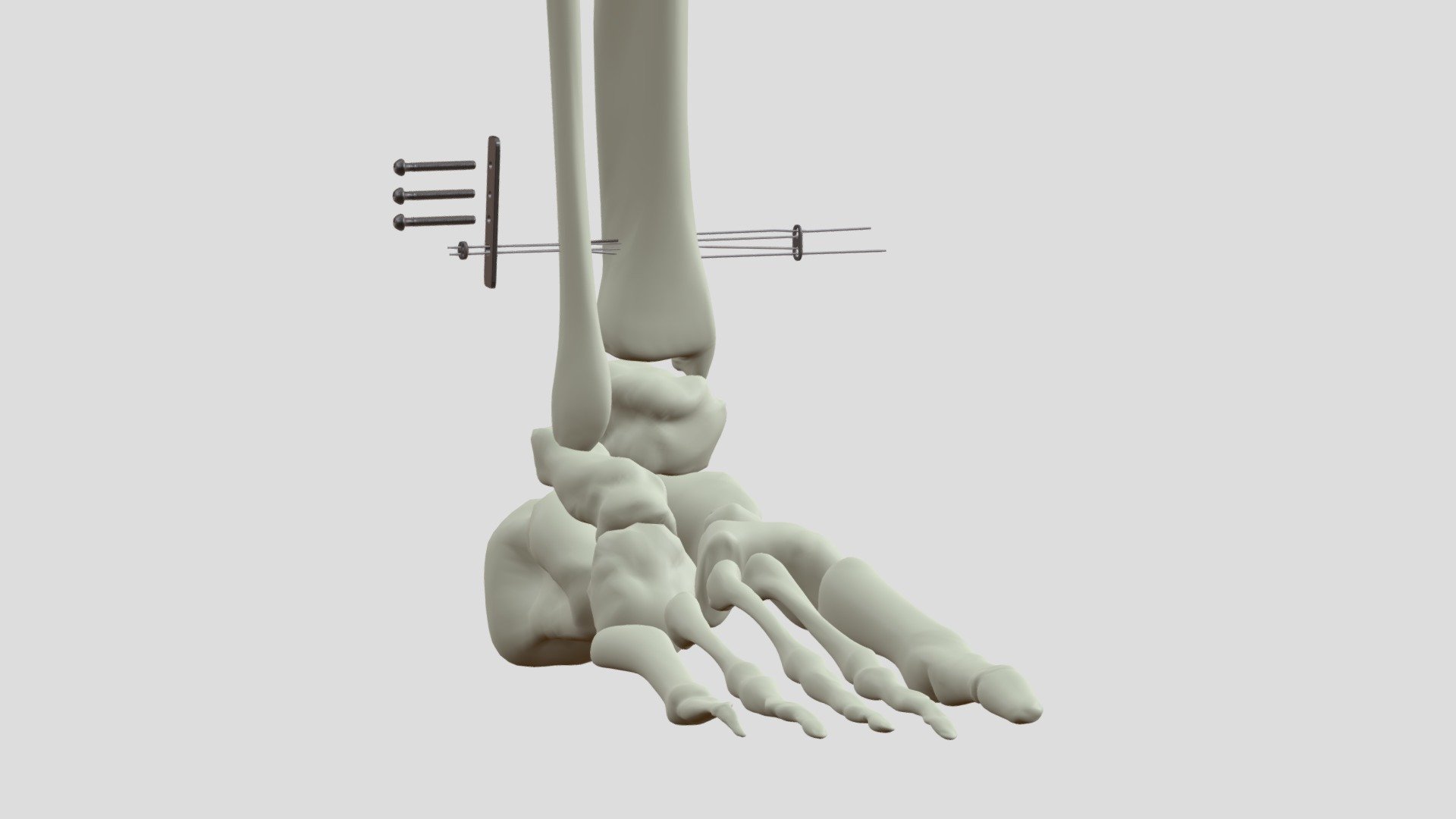Suture button animation - Download Free 3D model by Impact Science ...