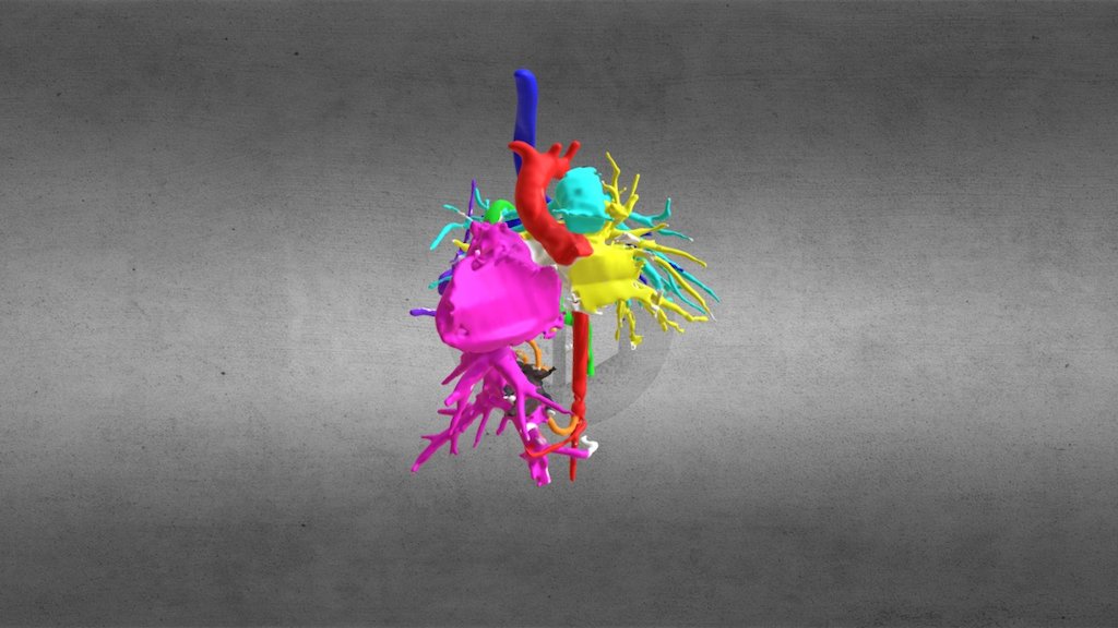 Coiled Aortopulmonary AVM