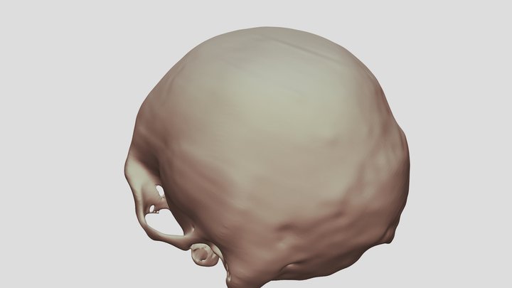 Skull Fracture-Sept-2021 3D Model