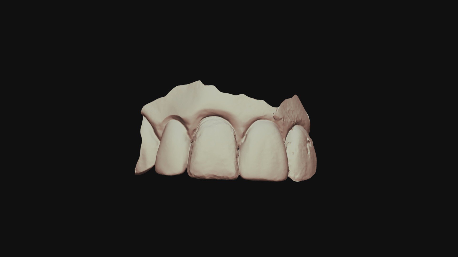 Group 9 #8 Waxup Upper Jaw (1)