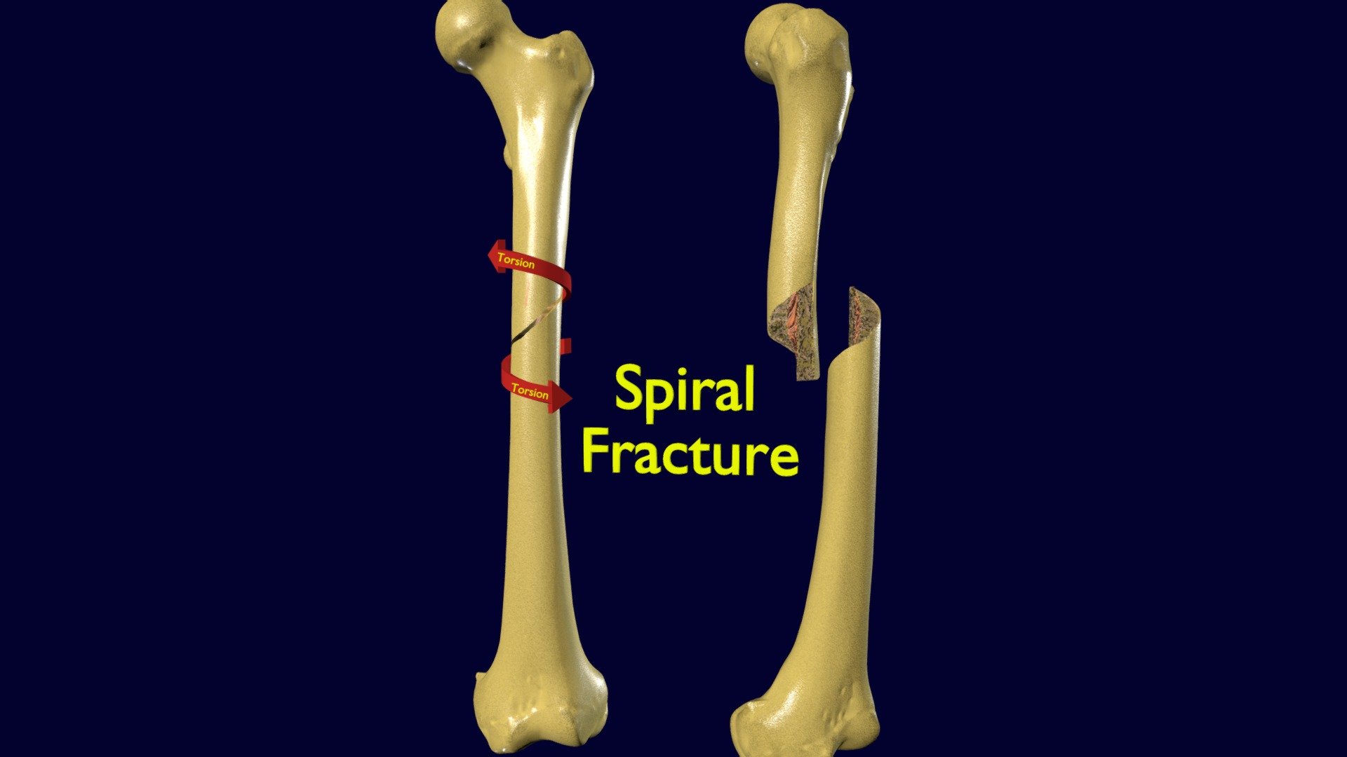 oblique-fracture-symptoms-causes-treatment