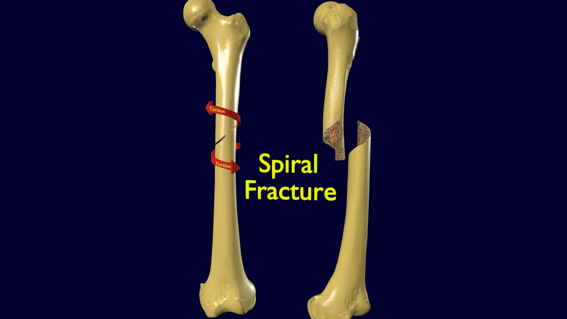 3D model Spiral Fracture skeleton labelled femur - This is a 3D model of the Spiral Fracture skeleton labelled femur. The 3D model is about a pair of bone bones.