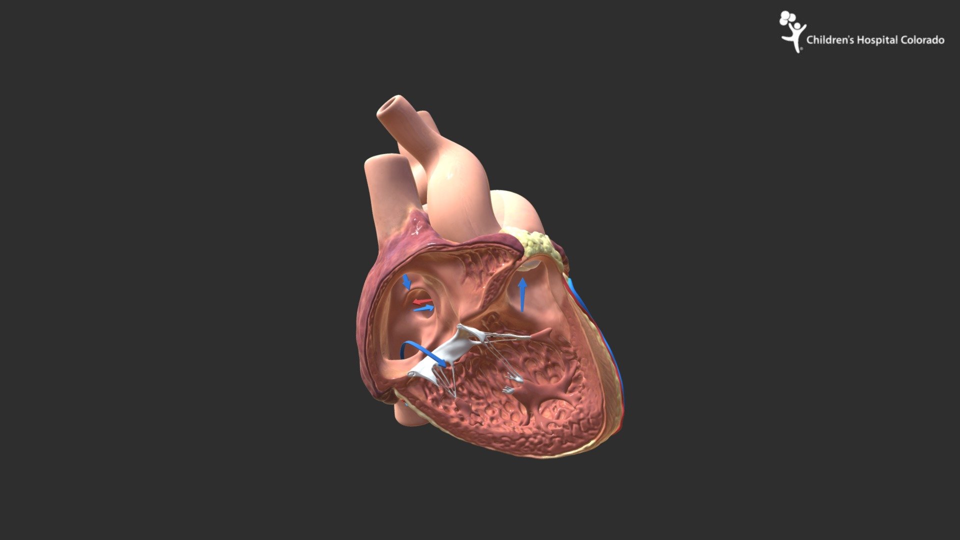 Atrial Septal Defect (cross section) - 3D model by Children's Hospital  Colorado Medical Media (@CHCOMedicalMedia) [0dc2bfc]