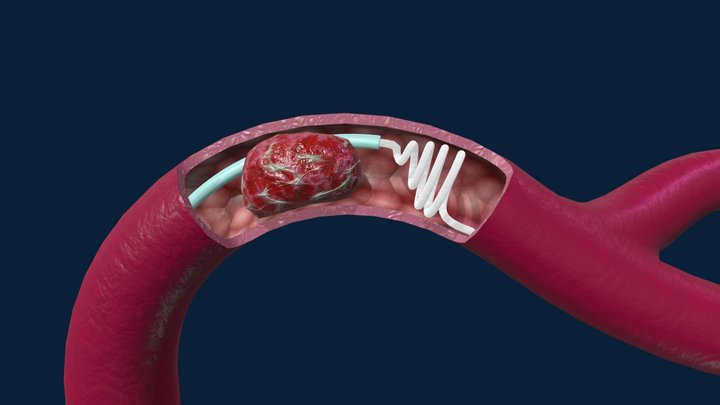 Mechanical Thrombectomy 3D Model