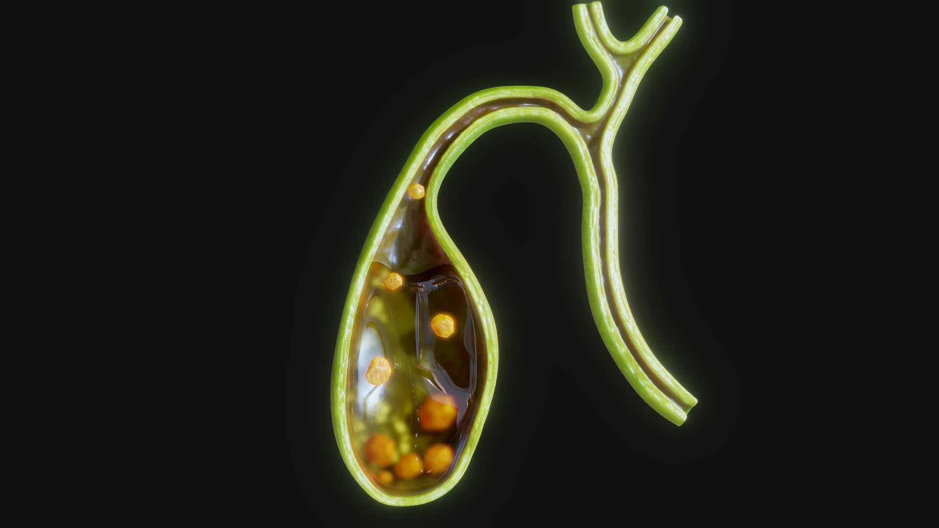 Gallbladder with Gallstones - Buy Royalty Free 3D model by zames1992 ...