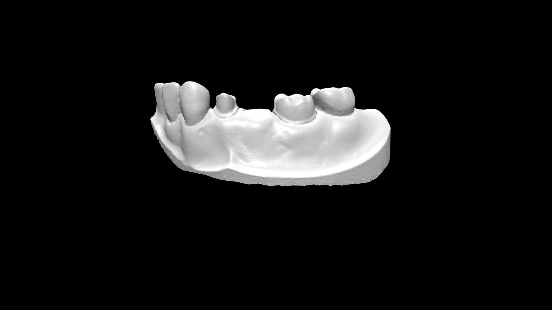 Fixed Partial Denture - High Resolution
