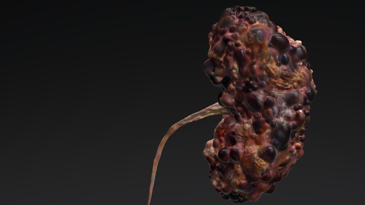 Polycystic kidney 3D Model