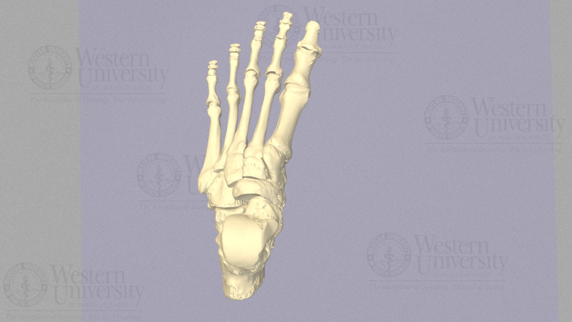 Metatarsus Adductus Compensation with Correction 3D model by