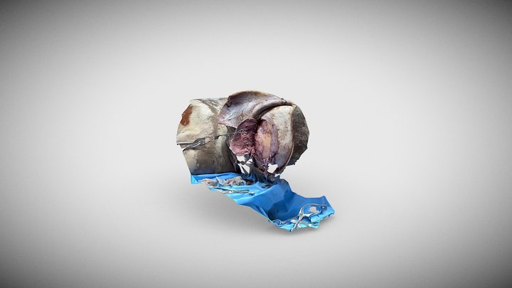 Craniotomy 3D Model