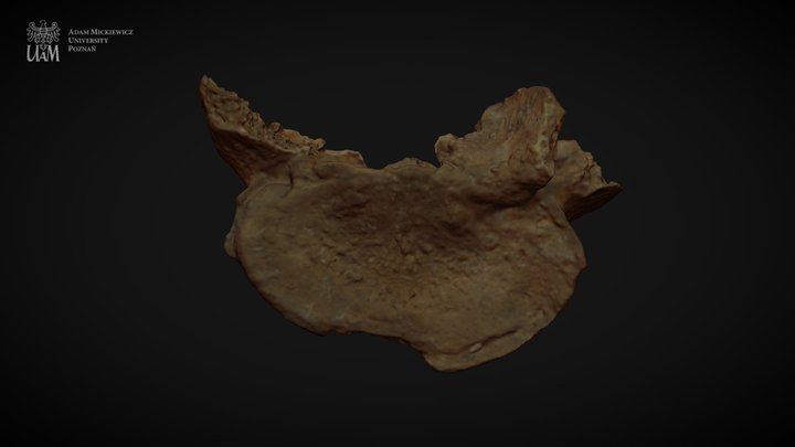 Achondroplastic dwarf - L5 3D Model