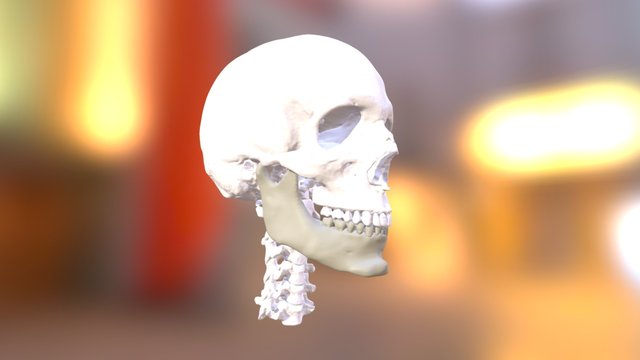 Jaw Surgery + Facial Implants (Post Jaw Surgery) 3D Model