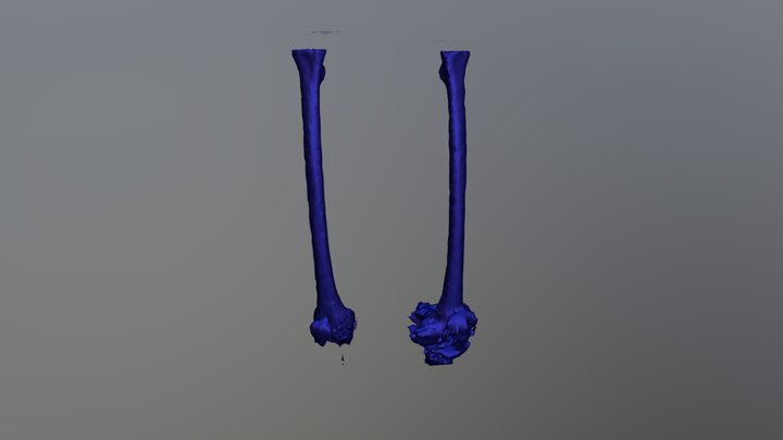 Femur Segmentation 3D Model