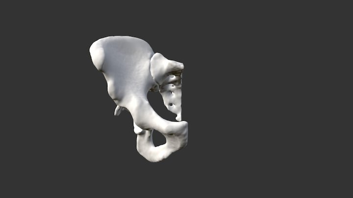 Pelvis Fracture - Posterior Wall 3D Model