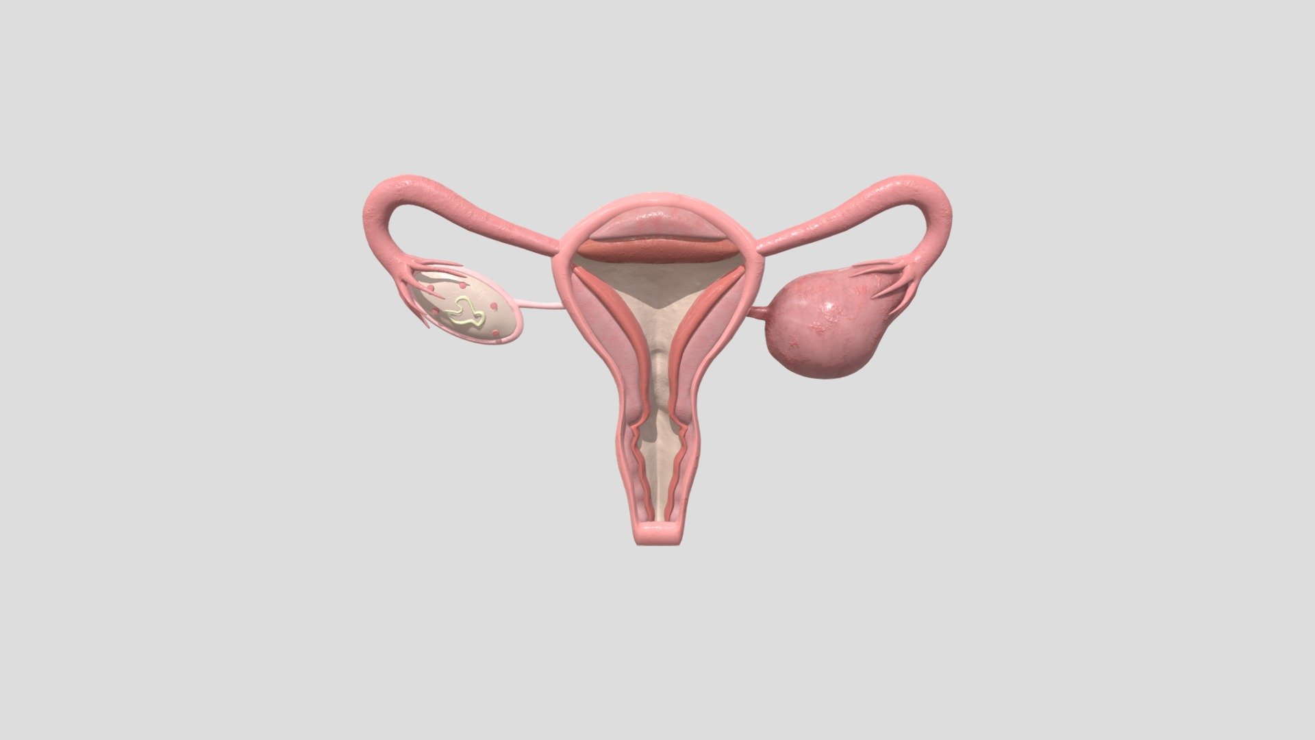 OV_CYST_INSIDE