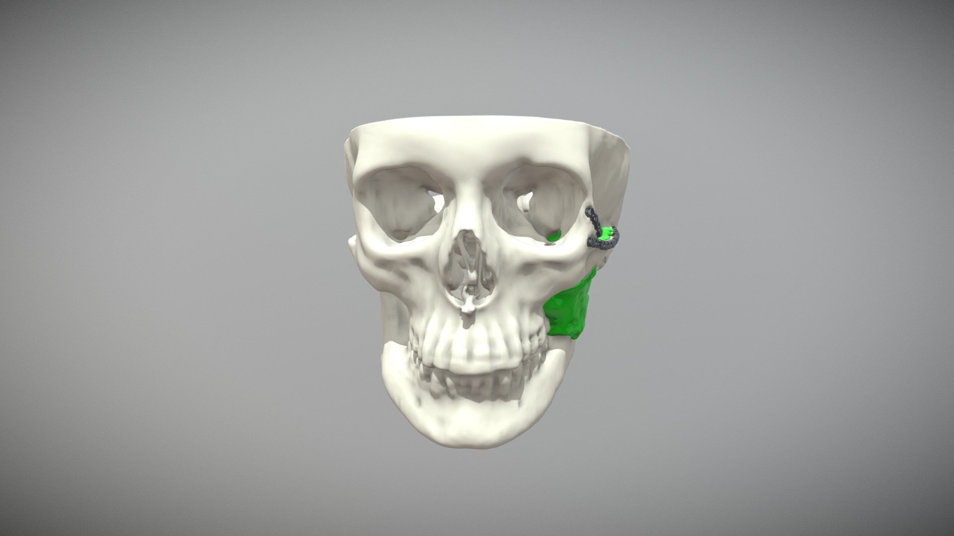 Recurrent Rhabdomyosarcoma (Rare Muscle Tumor) - 3D model by MMI2018 ...