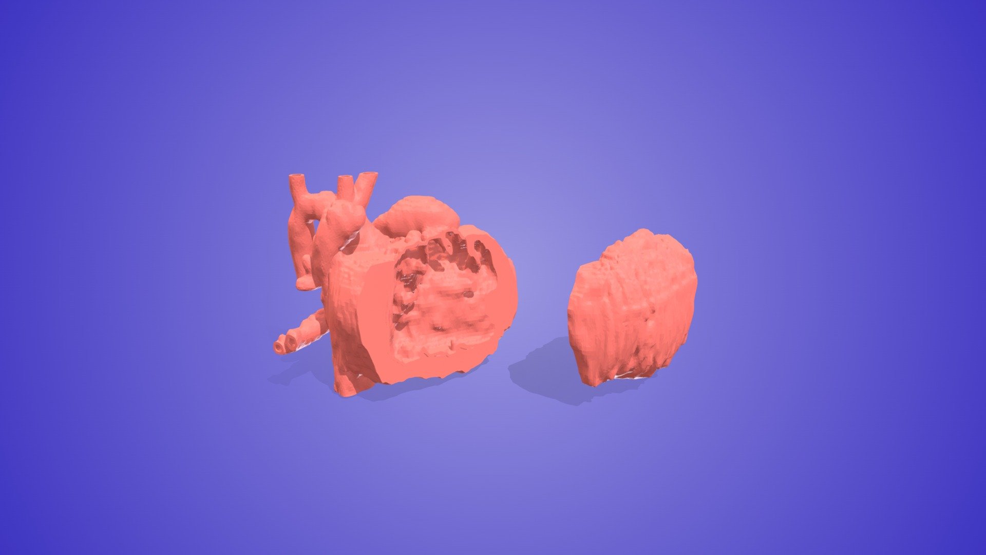 Repaired Tetralogy of Fallot