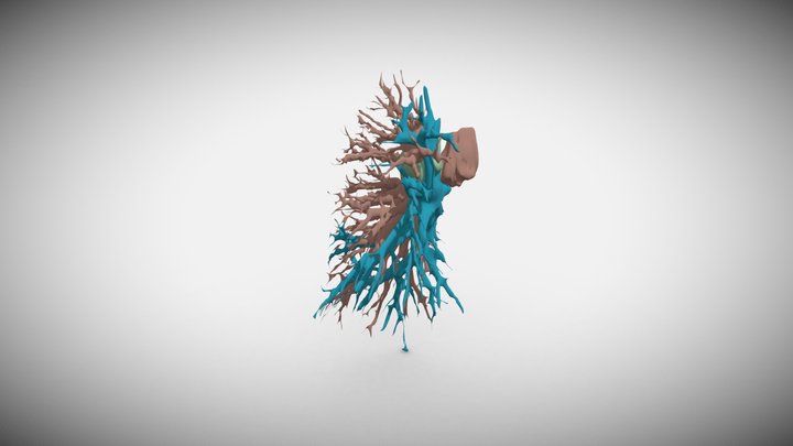 lung tumor 3D Model