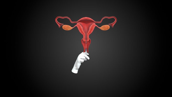 Intrauterine Insemination 3D Model