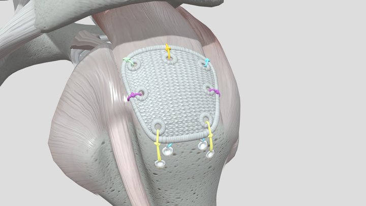Pitch-Patch Arthroscopic Technique 3D Model