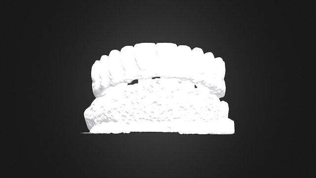 Implant Supported Fixed Denture 3D Model