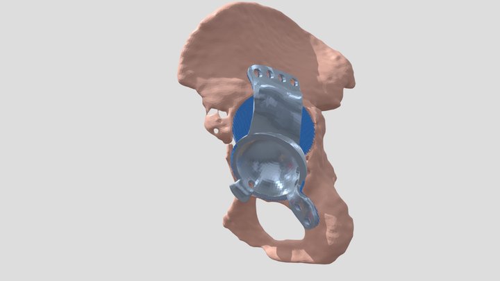 Prótesis de cadera paciente NL 3D Model