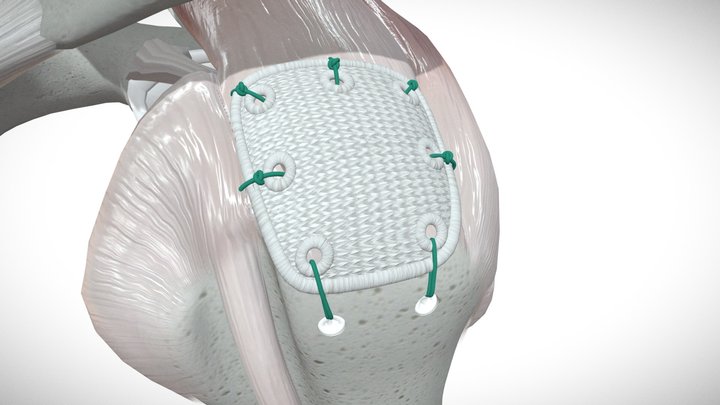 Pitch-Patch Open Technique 3D Model