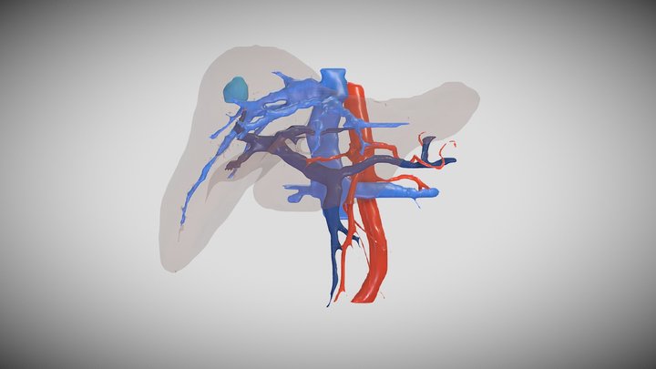 Metástasis hepática 3D Model