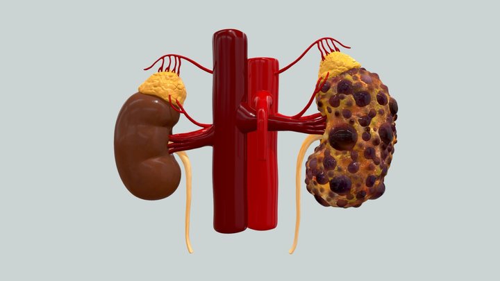 Polycystic Kidney Disease 3D Model