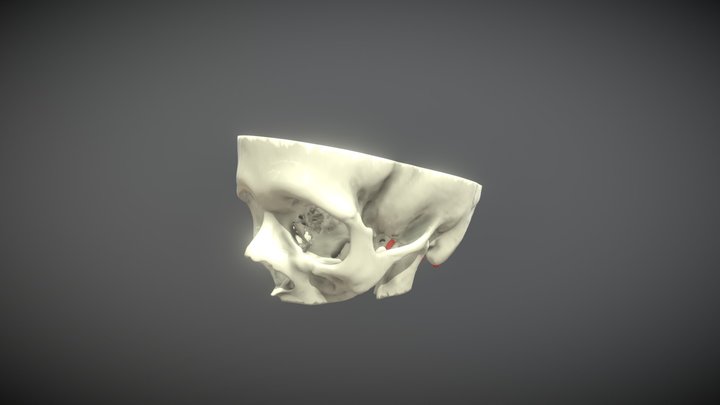 paciente con aneurisma 3D Model