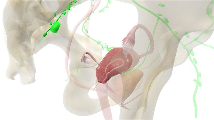 Baarmoederhalskanker 3D Model