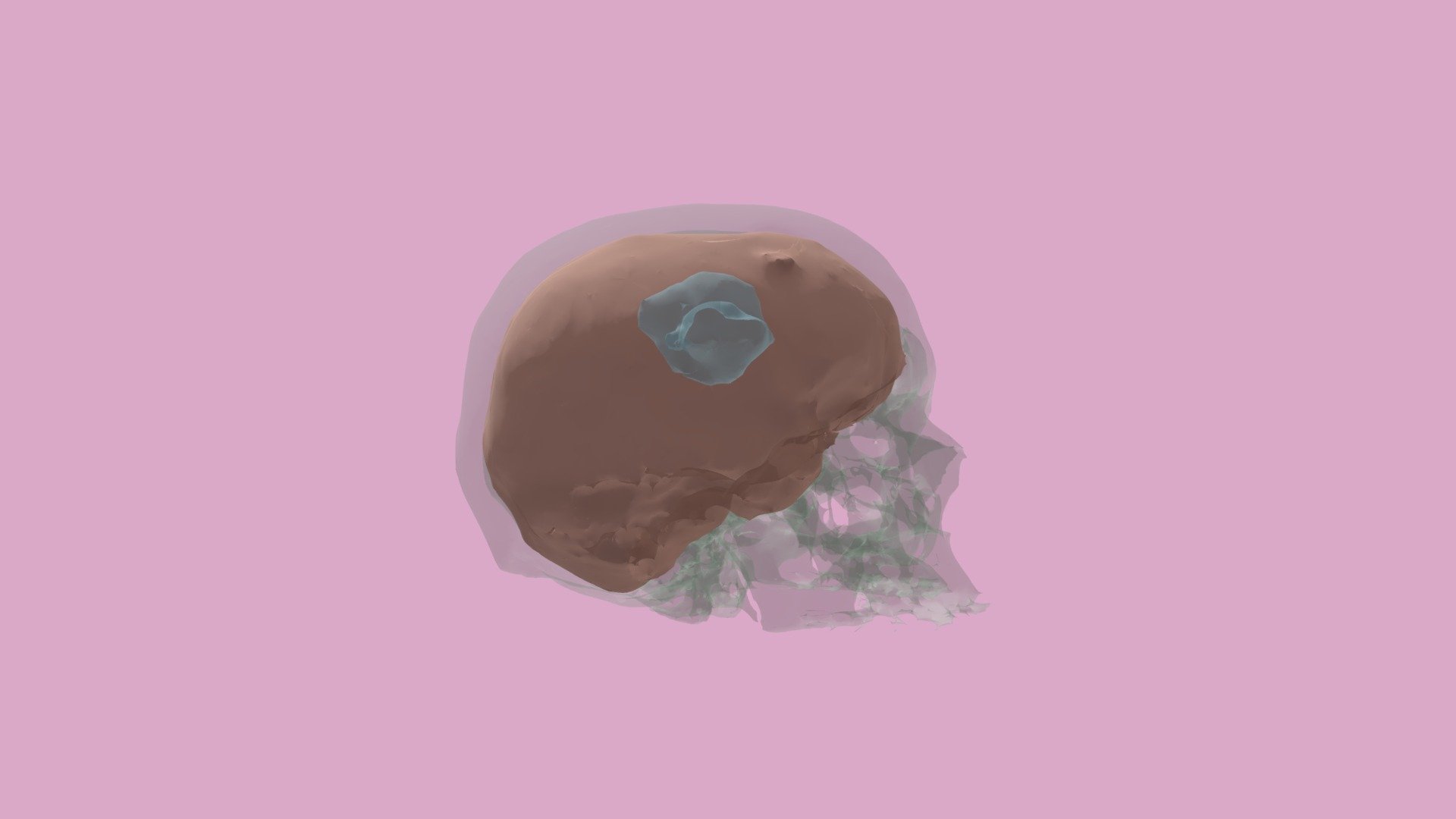 Exam 3 Segmentation of Skull, Brain, and Tumor