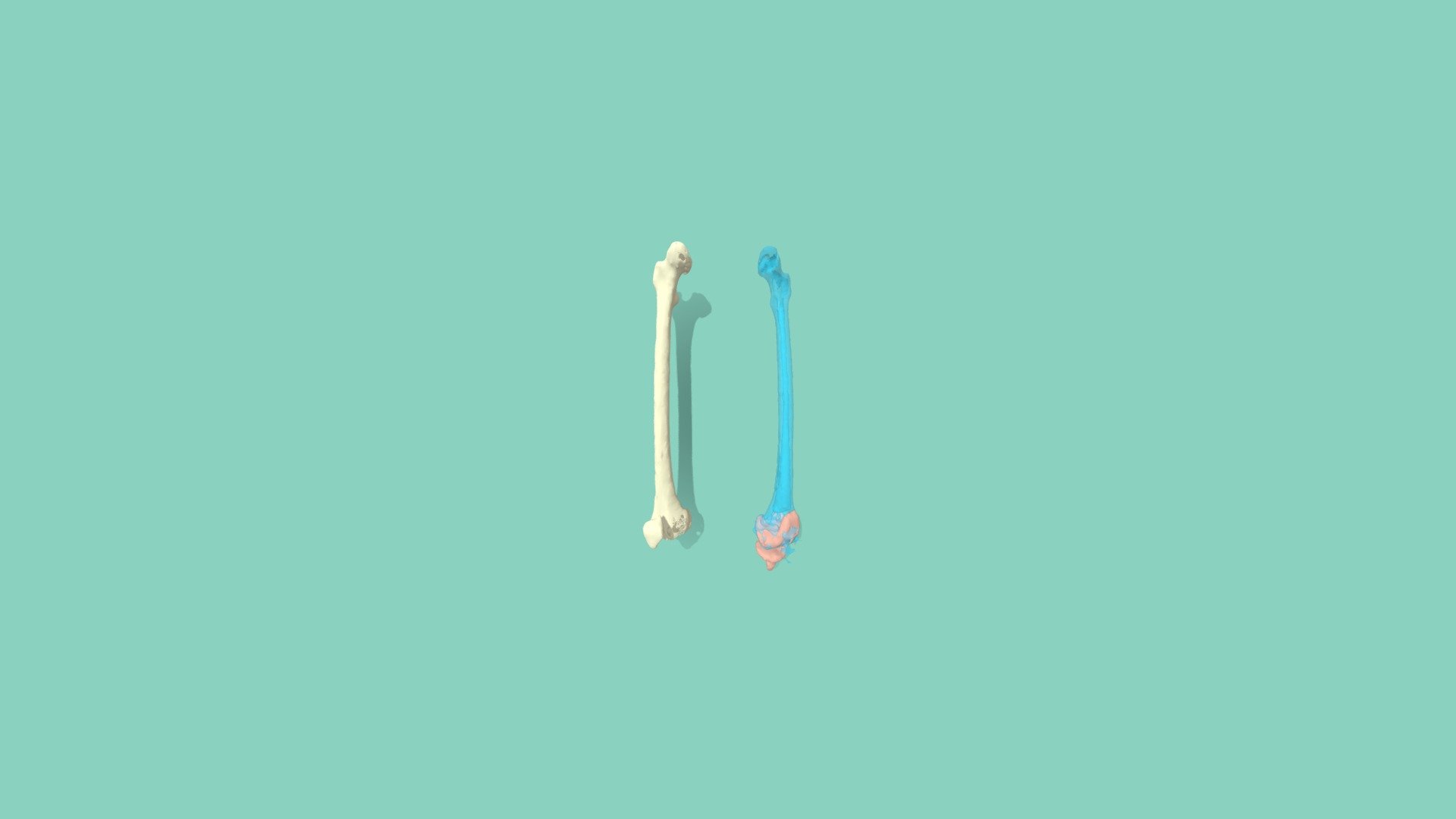Femur Segmentation and Implant