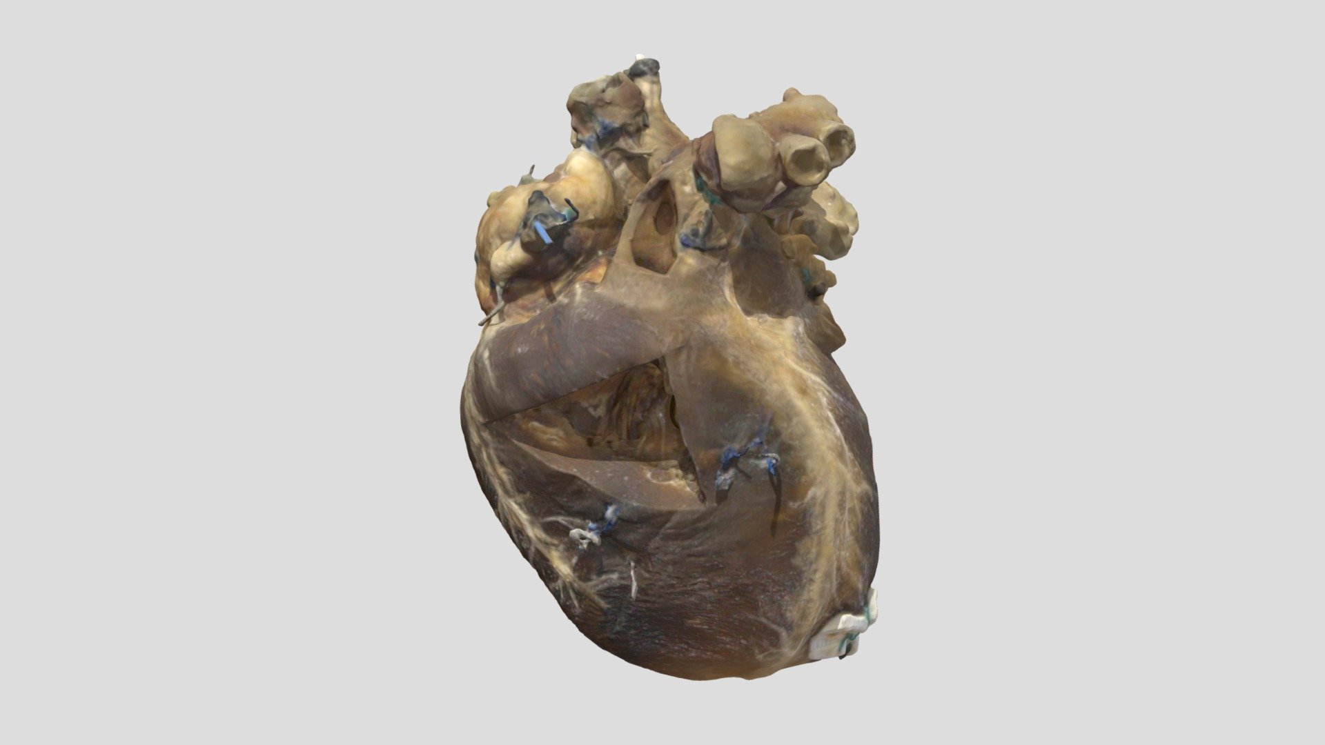 Transposition of Great Arteries_A80122
