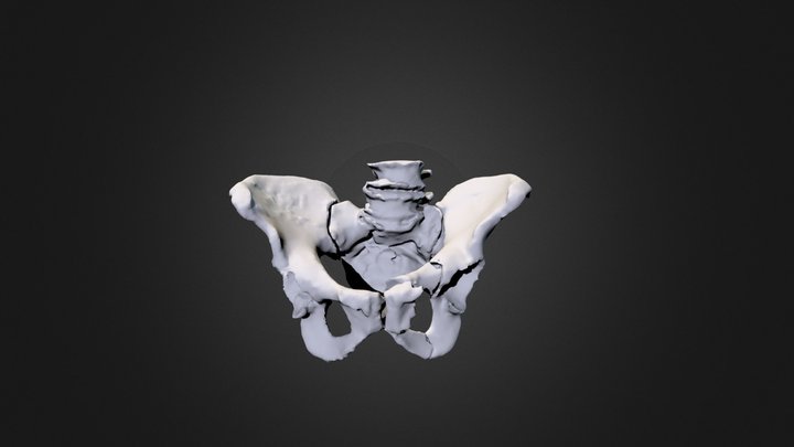 pubic bone and intestinal fracture | M-1506008 3D Model
