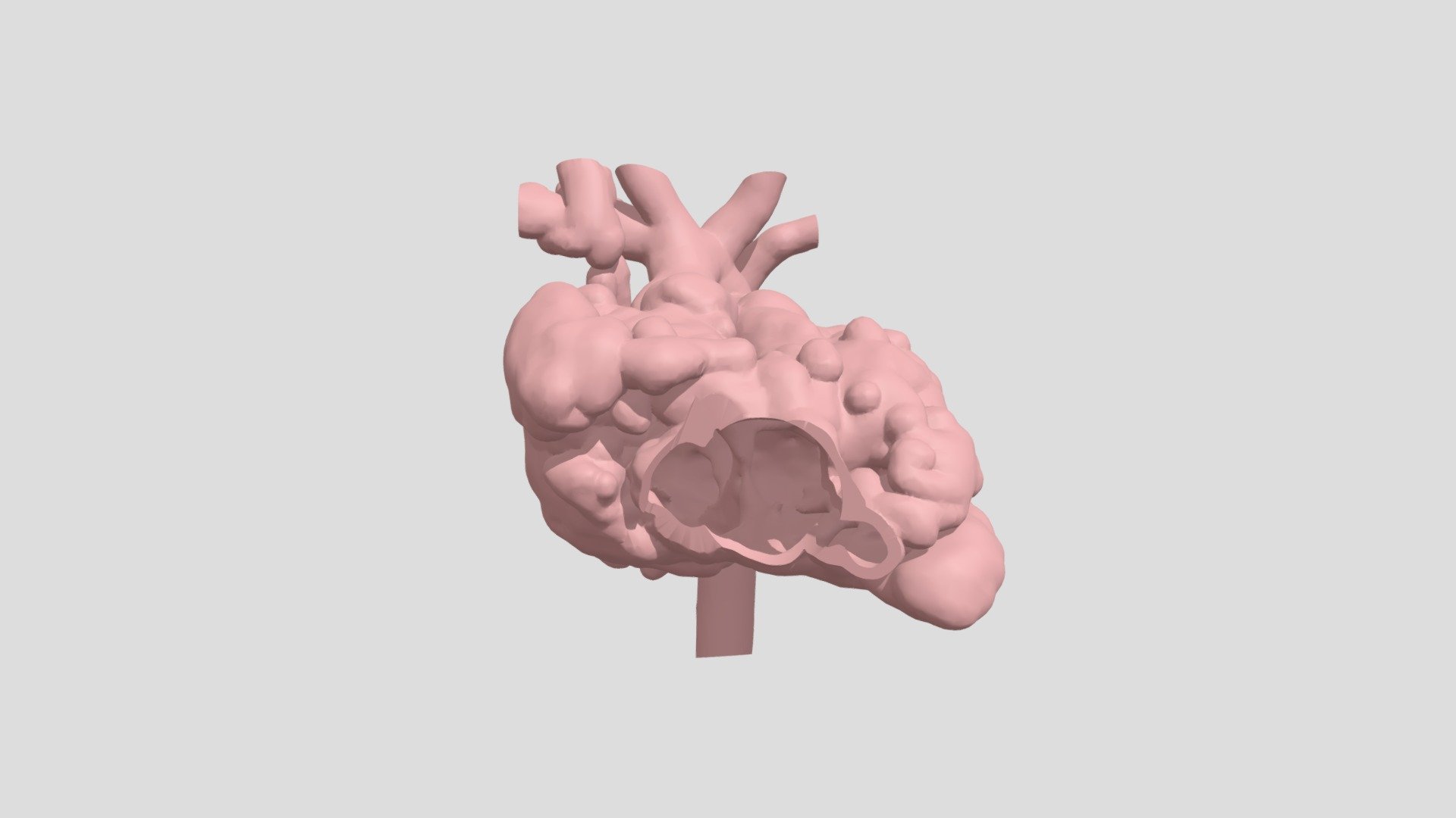 DORV, VSD, Hypoplastic LV (S0331) - 3D model by NCHS Cardiac Advanced ...